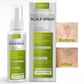 Folliculitis Scalp Spray | Relief for Itchy, Irritated & Dry Scalp Treatment | Antifungal, Formula for Healthy Hair Follicles | Soothing Folliculitis Treatment for Fungal Acne, Dandruff & Psoriasis