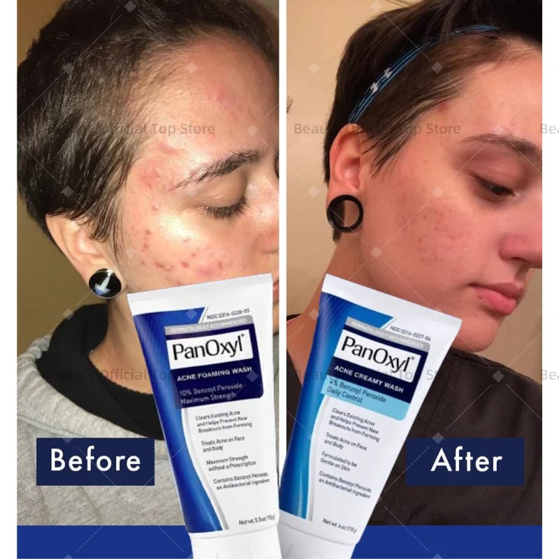 PanOxyl Acne Foaming Wash